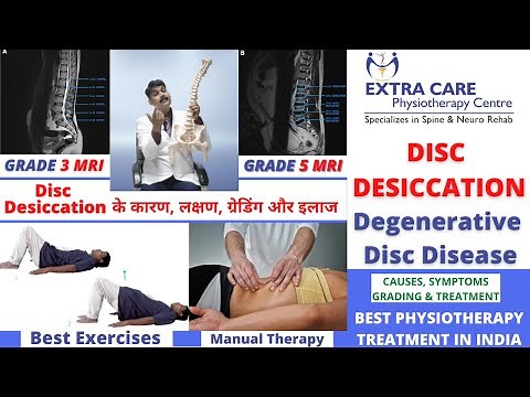 DISC DESICCATION in SPINE | Degenerative Disc Disease | Causes, Symptoms, Grading & TREATMENT