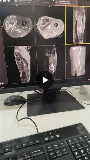mri left thigh lipo sarcoma done on  magnetom Vida.  typically appears as a mass with both fatty and non-fatty components, distinguishing it from a benign lipoma which is almost entirely fat.