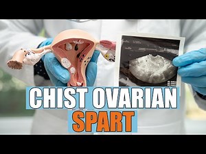 Chist ovarian spart: semne și simptome