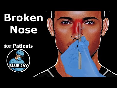 Nasal Fractures: Patient Education