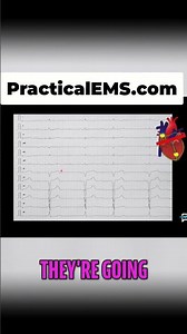 Master EKG: Decode Third-Degree Block P-Waves NOW! #shorts