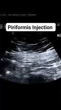 Piriformis Injection ultrasound guided