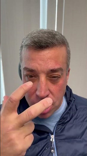 1 week post septoplasty, endoscopic sinus surgery, nasal valve repair and UPPP-doing well