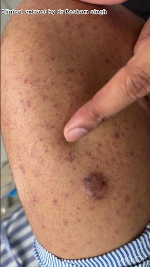 Petechiae and purpura in thrombocytopenia