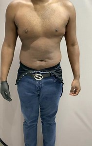 Liposuction of the Chest, abdomen and back with fat transfer to the buttocks (Brazilian Butt Lift)