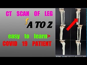 CT SCAN OF LEG Technique,(Toshiba 164 slice)