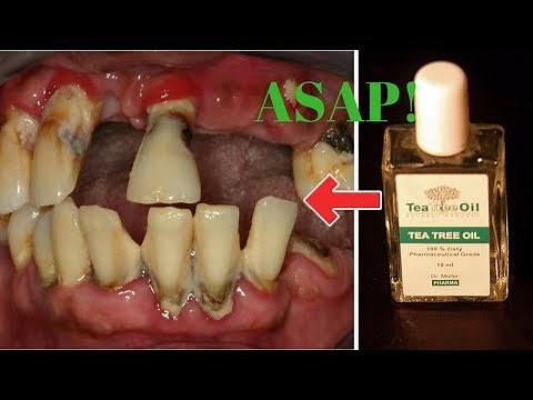 1 Dynamite Way To Curing Periodontal disease – Tea Tree Oil! 