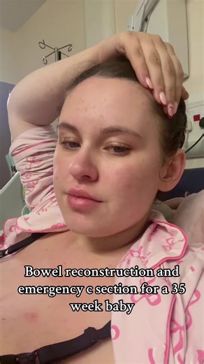 Bowel Reconstruction Surgery for 35-Week Baby
