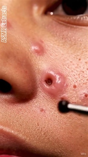 ASMR Extracts | Blackhead Zoom