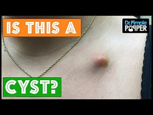 THIS "cyst" worried me as soon as I started surgery