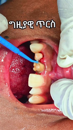 #HealthySmile #fyp #dentalimplants