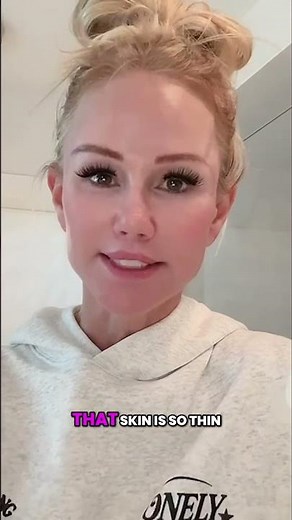 Under Eye Wrinkles in Your 20s?