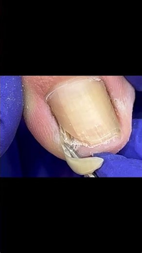 Ingrown Toenail Trimming - Professional Pedicure #satisfying