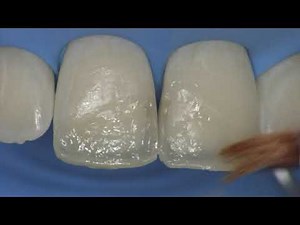Class IV Restoration with Style Italiano Technique - Dr. Walter Devoto