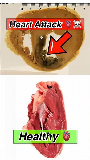 HEART ATTACK vs HEALTHY HEART | 🔬Comparing Cells #cardiology #medicalstudent