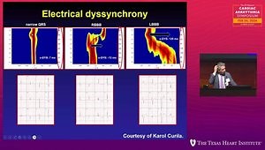 Conduction System Pacing