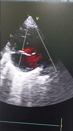 complete AV canal defect RASTELLI TYPE A