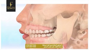 177K views · 2.9K reactions | تقويم الاسنان هو حل مثالي حتى تصير...