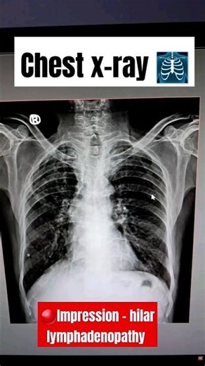 hilar lymphadenopathy #lungsproblem #xray #education #radiology #medical #study #shorts