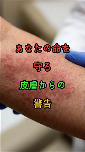 あなたの命を守る皮膚からの警告これが出たらすぐ受診 #70代 #がん予防