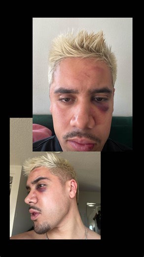 Los Angeles County sheriff’s deputies are investigating an assault reported Thursday morning near West Hollywood Park, on N Robertson Boulevard, authorities said. Deputies responded after a man reported being attacked near the park, close to The Abbey WeHo, according to the West Hollywood Sheriff’s Station at roughly 1:30 a.m. The victim, who identified himself as Saint, told WEHO TIMES he was walking south on Robertson Boulevard when a woman he did not know approached him aggressively and threa