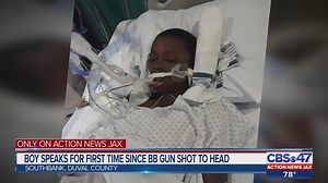 Boy shot in head with BB gun speaks, eats for first time since incident