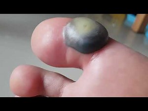 A blister after 30 hours from liquid nitrogen cryotherapy