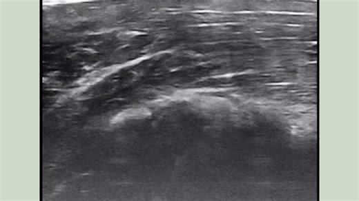 Rare presentation of Calcific Biceps Tendinopathy. One compelling indication for fenestration & PRP injection. Chronic anterior shoulder pain in a gym trainer. #chronicpainmanagement #ultrasound #painrehabb #shoulderpain #regen #anatomy #cancer #paineducation | Madhan Pandian