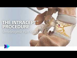 How the Intracept Procedure works
