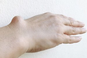 Wrist and hand cysts: what to know and how to treat them