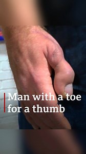 26K views · 96 reactions | Toe-riffic news  Cobbler David Lee lost his thumb in an accident and has had it replaced with his big toe. | BBC Nottingham | Facebook
