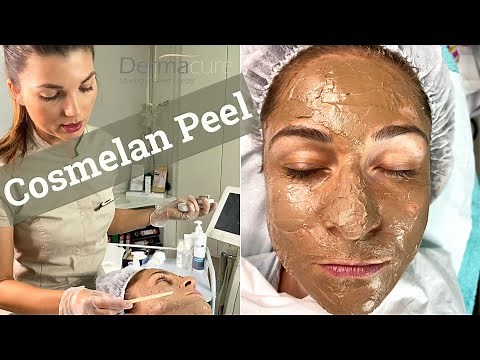 COSMELAN PEEL- THE NUMBER ONE PEEL FOR PIGMENTATION, MELASMA, SUN DAMAGE, ACNE, AND ACNE SCARRING