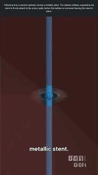 Coronary Angioplasty