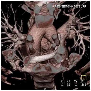 Cardiac: Compression of trachea by right aortic arch with attempted double aortic arch (5 of 5)