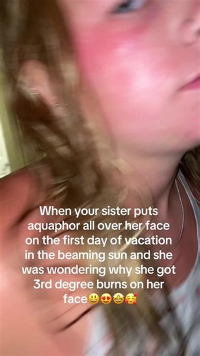 Protecting Against Sunburn: The Power of Aquaphor
