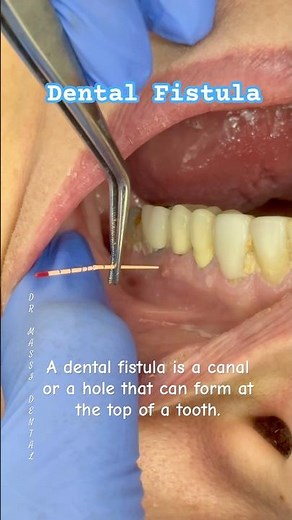 FISTULA…“Let’s go see where the gutta-percha leads 👀”