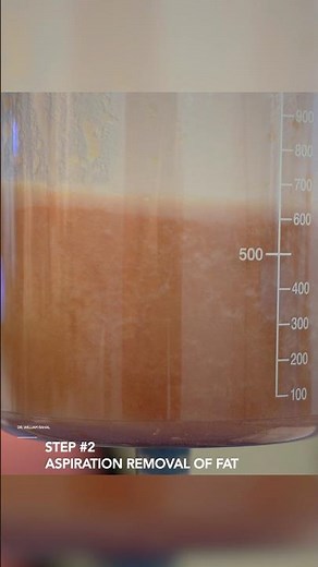 Gender Affirming Surgery - 360 Lipo & BBL with Rib Remodeling! Before & After Results!