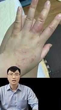 Da Tay Chân Nổi Mụn Nước Không Ngứa – Phân Biệt Với Bệnh Nấm Da Hay Viêm Da Cơ Địa?