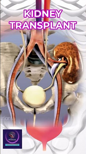 Kidney Transplant Procedure: Steps, Recovery, and Success Rate Explained