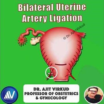 Bilateral Uterine Atyery Ligation