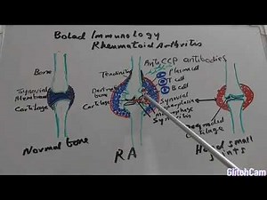 Pathophysiology of Rheumatoid arthritis