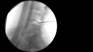 Transforaminal Endoscopic Discectomy: Tips and Tricks