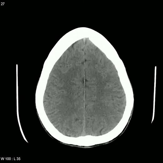 Colpocephaly CT
