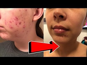 How to Heal a Popped Pimple Scab