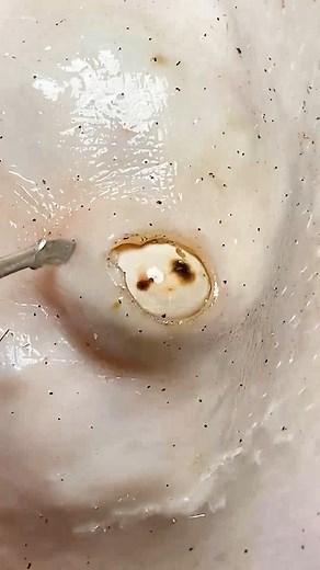 42K views · 157 reactions | Something Unexpected Was Buried Deep in This Toenail N448 #toenails #pedicure #OddlySatisfying #fblifestyle #fypシ Beautiful moments of care and relaxation through a gentle pedicure experience. Simple, clean, and satisfying. ￼ ￼ Disclaimer: This video is for educational and relaxation purposes only. All content belongs to the respective owners, no copyright infringement is intended. | Help remove ticks | Facebook