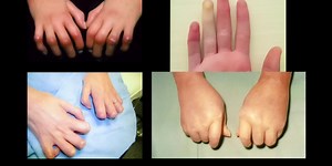 New drug shows promise for treatment and relief from systemic sclerosis