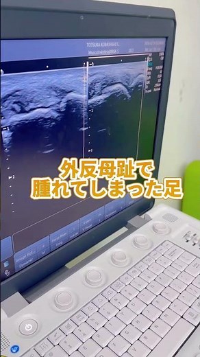 外反母趾で足が腫れる本当の理由。エコーで見る痛みの原因が意外すぎる！ #戸塚小林整骨院 ＃外反母趾＃足の痛み＃戸塚整体＃内反小趾