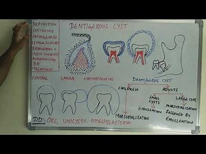 Dentigerous cyst