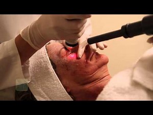 ActiveFX, DeepFX & Total FX procedure with Dr. Kristen Richards, Torrey Pines Dermatology, La Jolla