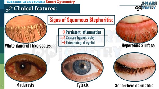 Blepharitis- Definition, Causes, Types, Symptoms, Signs, Tx & Complication - 睑缘炎
